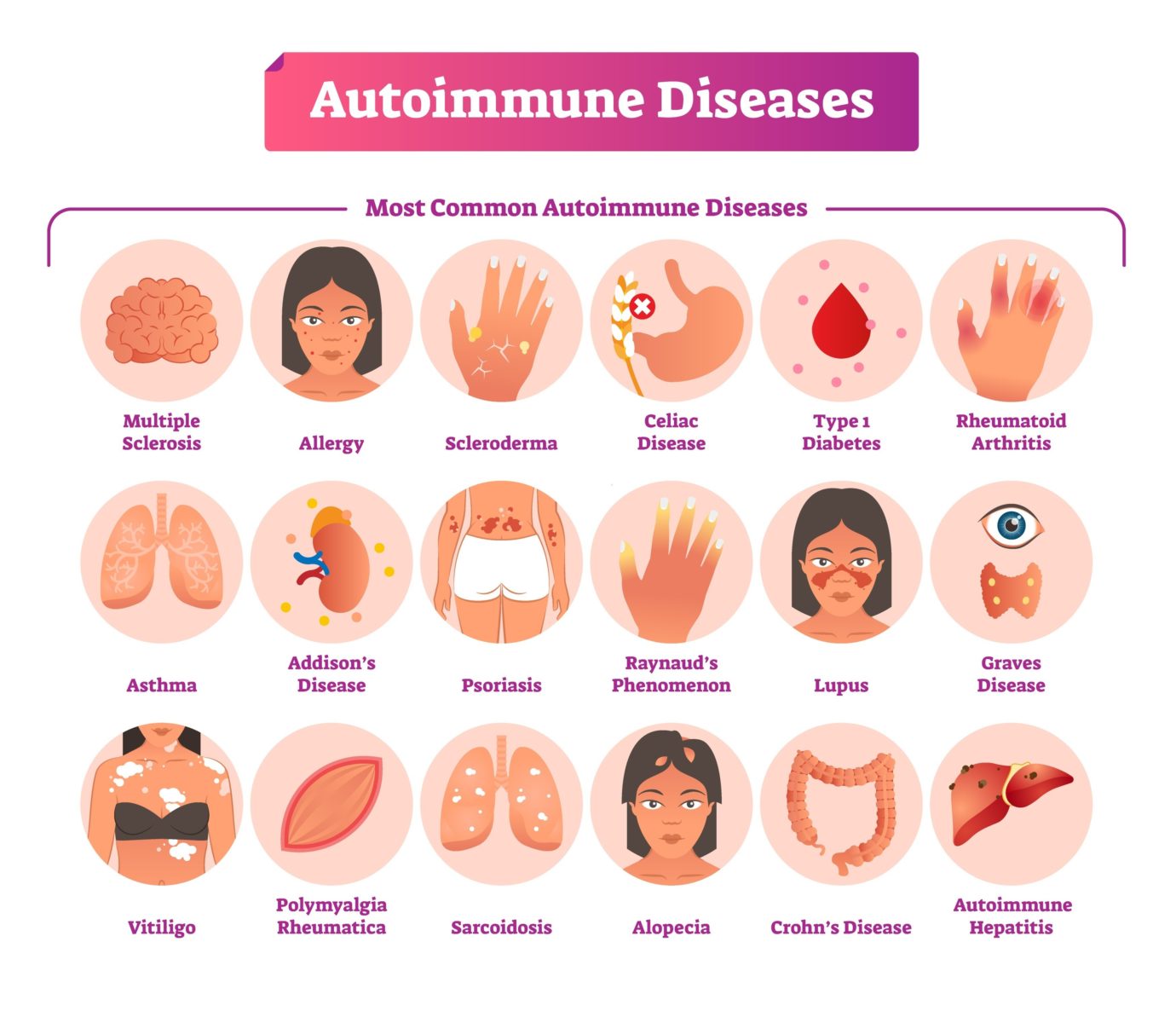 Autoimmune-illness-for-the-page-2017790152